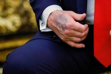 Trump, Elindeki Morlukların Sebebini Açıkladı